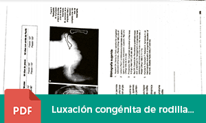 luxacion-congenita-rodilla